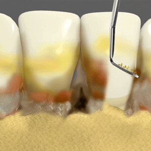 Periodontal